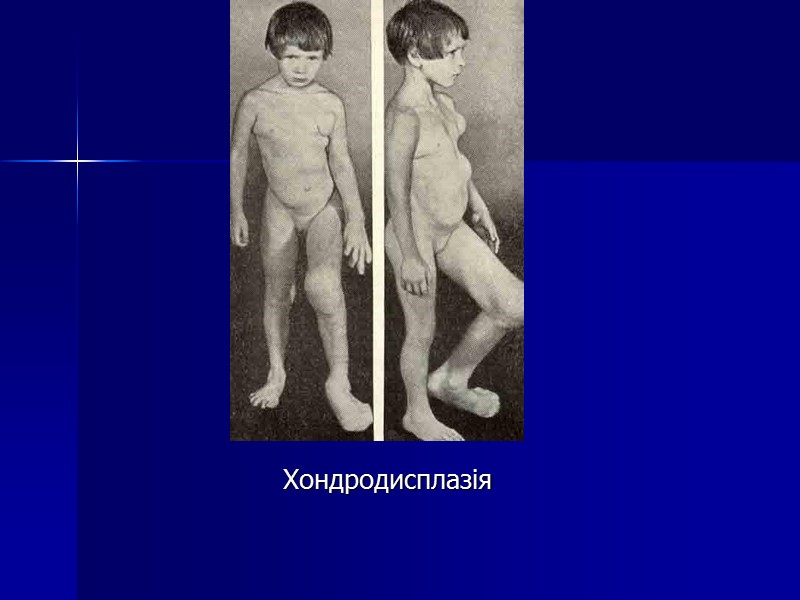 Хондродисплазія